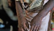 A patient with a severe form of the mpox epidemic is treated at the Kavumu hospital, 30 km north of Bukavu in eastern Democratic Republic of Congo, August 24, 2024. (Photo by Glody Murhabazi / AFP)