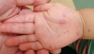 File photo for representational purposes showing a child's hand after being diagnosed with hand, mouth, and foot disease.