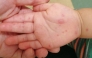 File photo for representational purposes showing a child's hand after being diagnosed with hand, mouth, and foot disease.